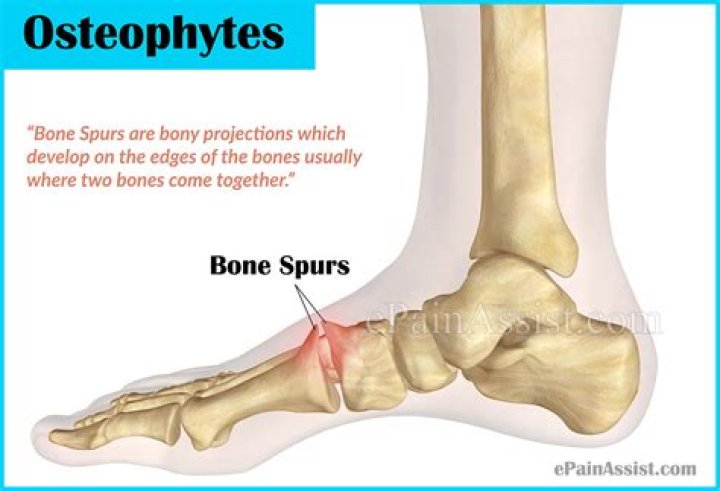 Are osteophytes bone spurs?